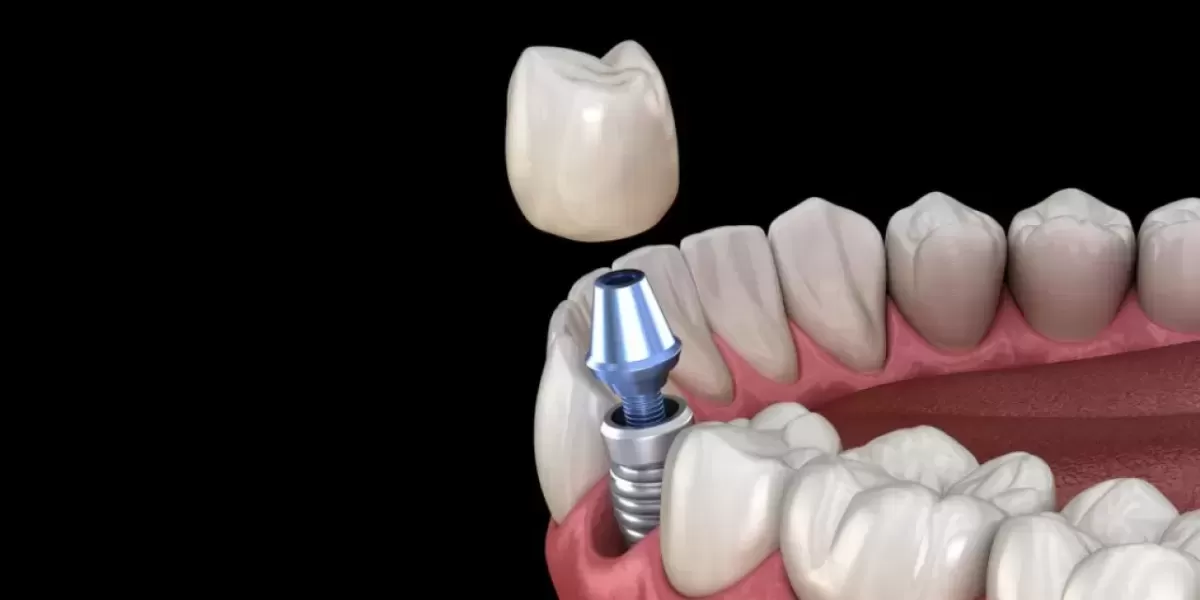 Zubni Implantati 